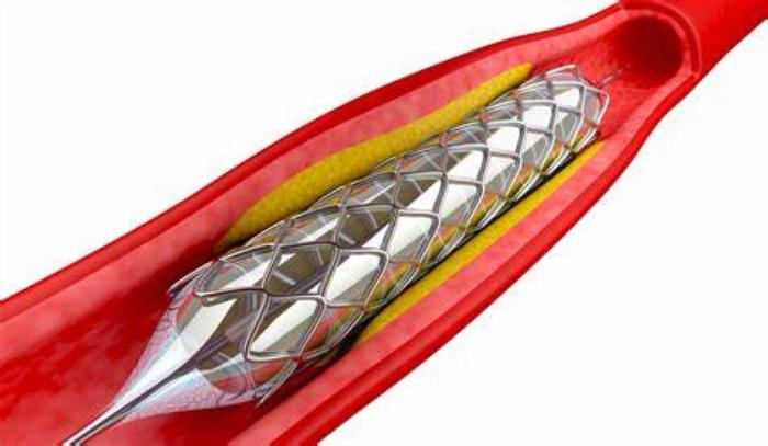 The Impact of Coronary Angioplasty on Quality of Life