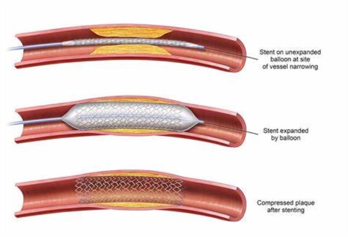 Evaluating Stent Performance