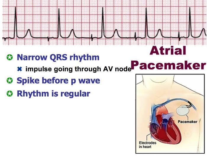 Overview of Heart Rhythm Disorders That May Require a Pacemaker