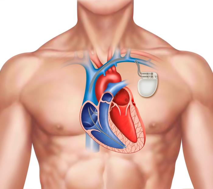 Common Risks Associated with Pacemaker Surgery