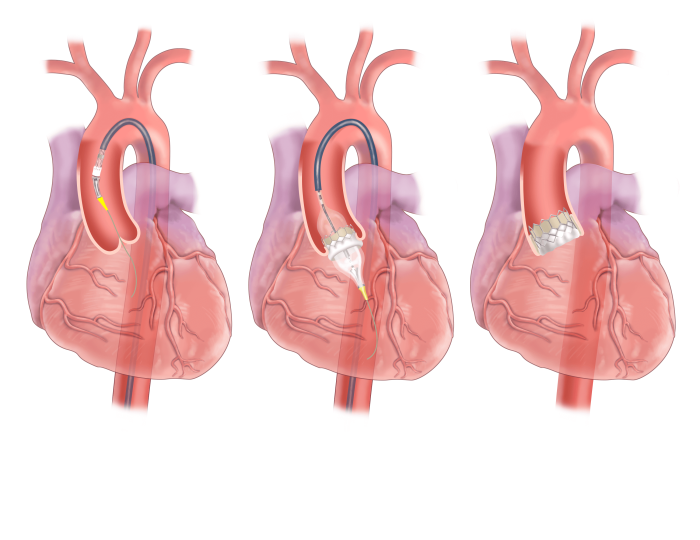 How TAVR Impacts Heart Function