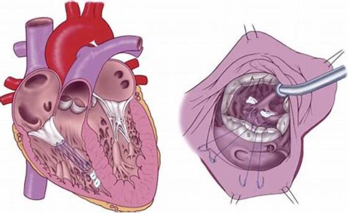 Robotic-Assisted Surgery for Tricuspid Valve Repair