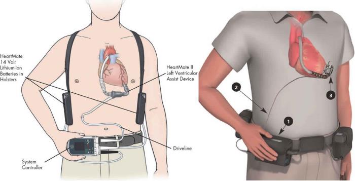 Preparing for LVAD Surgery