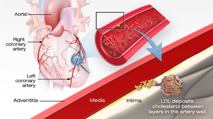 Role of Cholesterol in Heart Disease