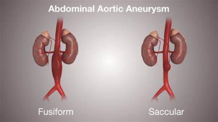 What Causes an Abdominal Aortic Aneurysm