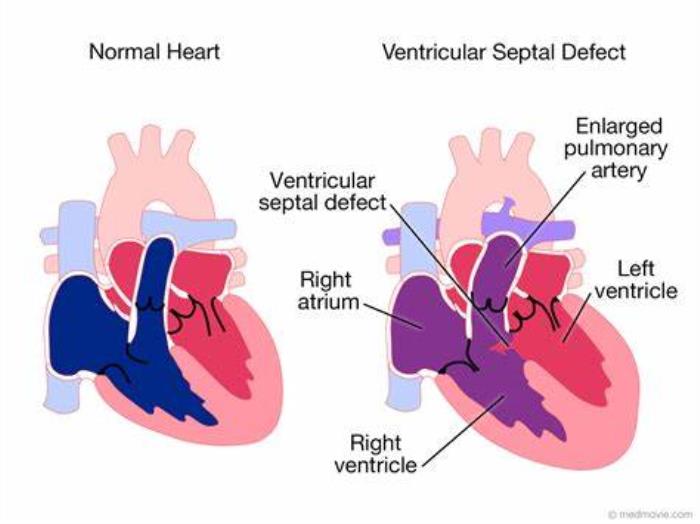 Common Imaging Techniques Used to Diagnose VSD