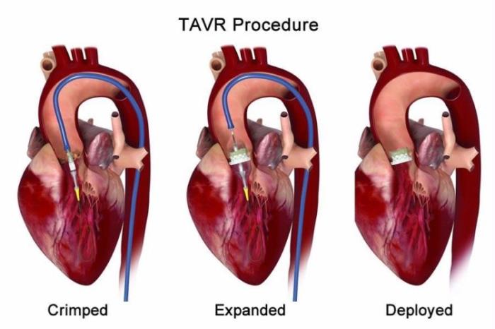 Common Causes Leading to the Need for TAVR Surgery