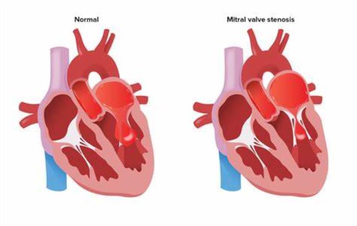 Common Causes Leading to Mitral Valve Damage