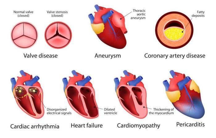 Common Heart Conditions Leading to AICD Surgery