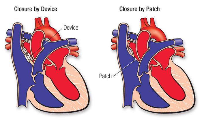 Why ASD Closure Surgery is Necessary