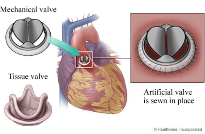 Types of Mitral Valve Replacement Surgery: Mechanical vs. Biological Valves