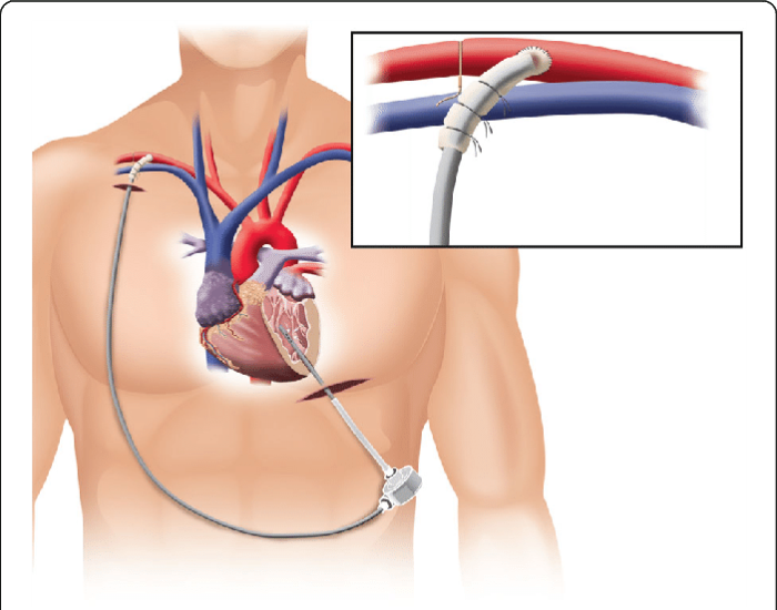 Recognizing Changes in Blood Flow and Pump Speed