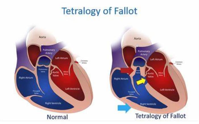 How Tetralogy of Fallot Affects the Right Ventricle’s Function