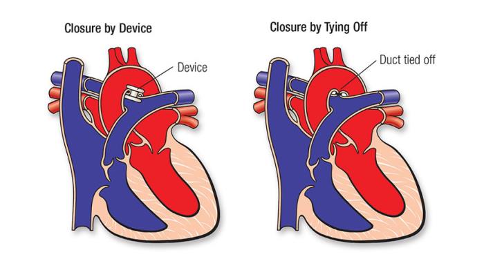 Enhanced Growth and Development in Children After PDA Closure