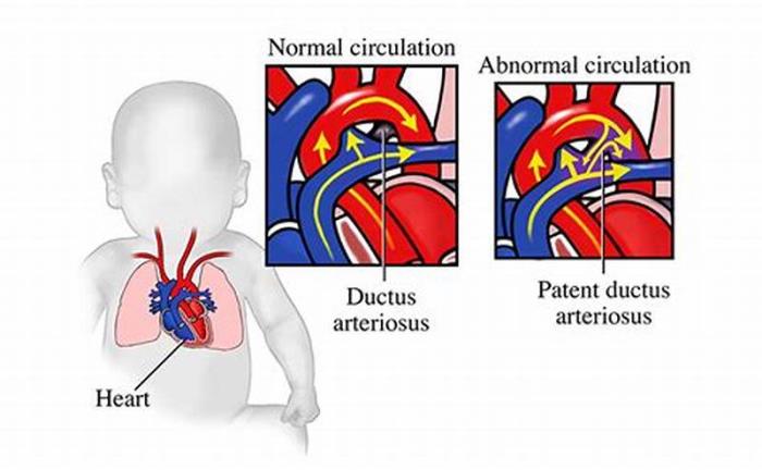 Common Signs of PDA in Newborns and Infants