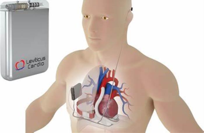 Types of LVAD Batteries