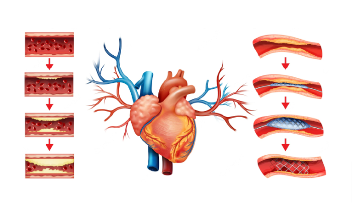 Recent Advances in Angioplasty Technology