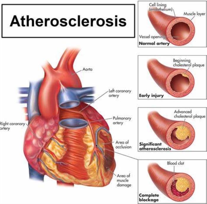 How Heart Disease Develops: The Role of Atherosclerosis