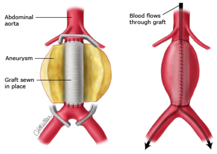 Traditional Treatment Options for Abdominal Aortic Aneurysm