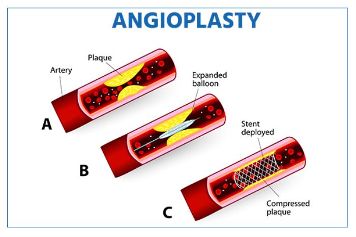 Preparing for Angioplasty