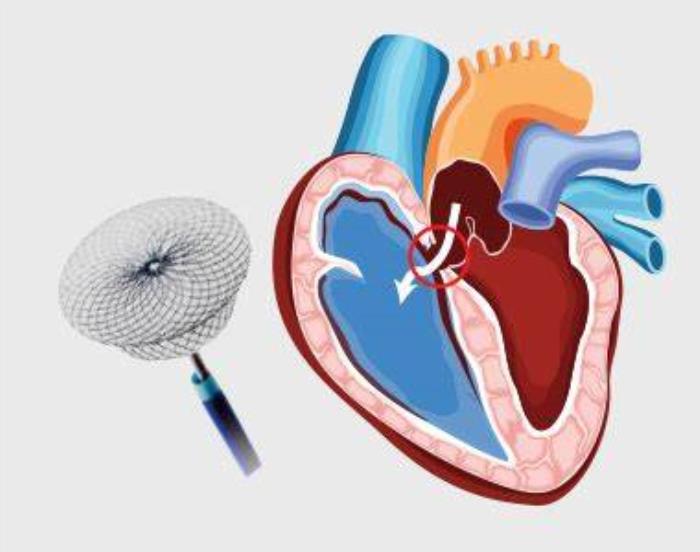 Overview of ASD Closure Devices