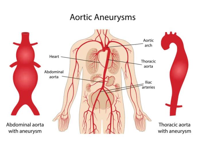 The Anatomy of Aneurysms