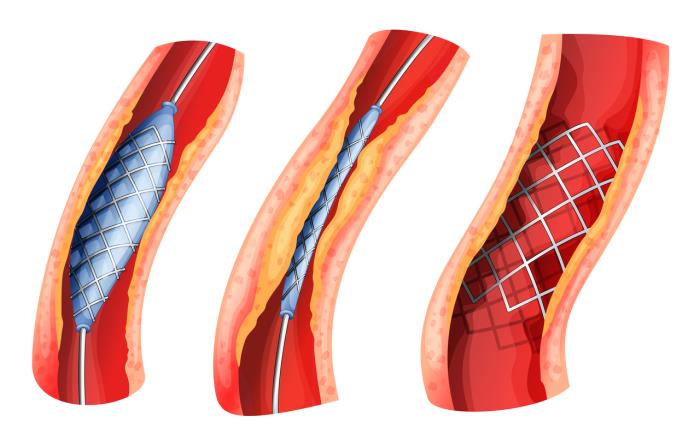 How Stents Work to Keep Arteries Open