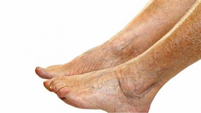 Swelling in the Legs and Feet