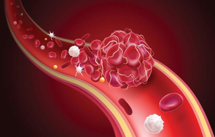 Risks of Thrombosis After Surgery