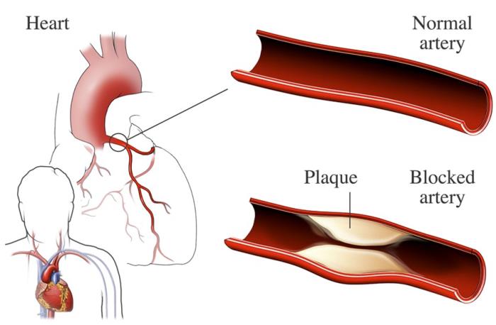 Coronary Artery Injury