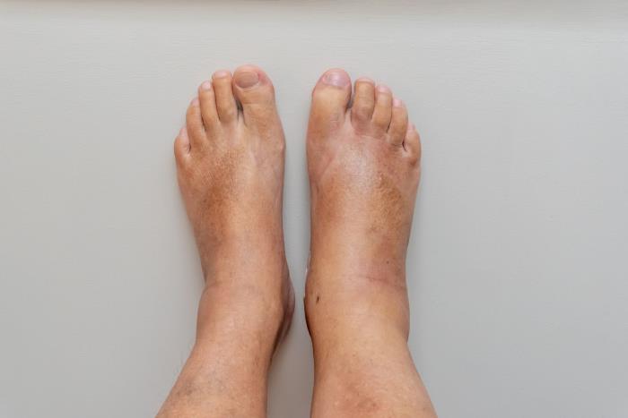 Swelling in the Legs and Feet