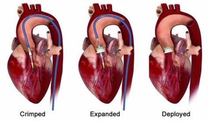 Common Signs of Valve Malfunction Post-TAVR