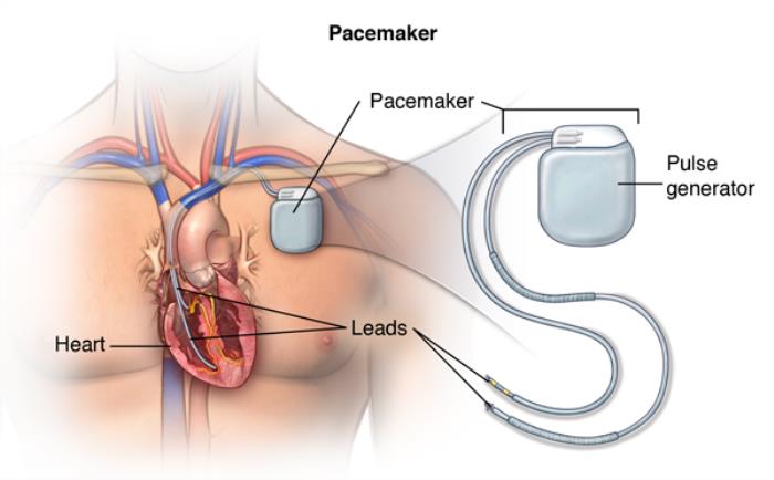 Signs of Infection at the Pacemaker Implant Site