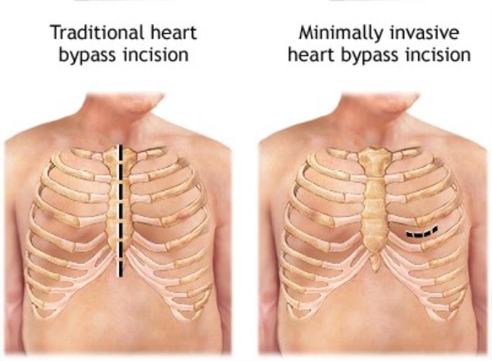 Traditional vs. Minimally Invasive Surgical Approaches for Tetralogy of Fallot