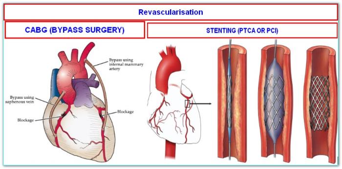 Long-Term Improvements in Heart Function After Surgery