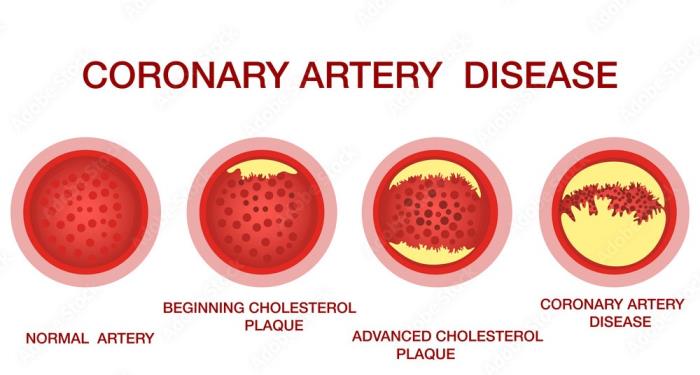 Understanding Cholesterol and Coronary Artery Disease