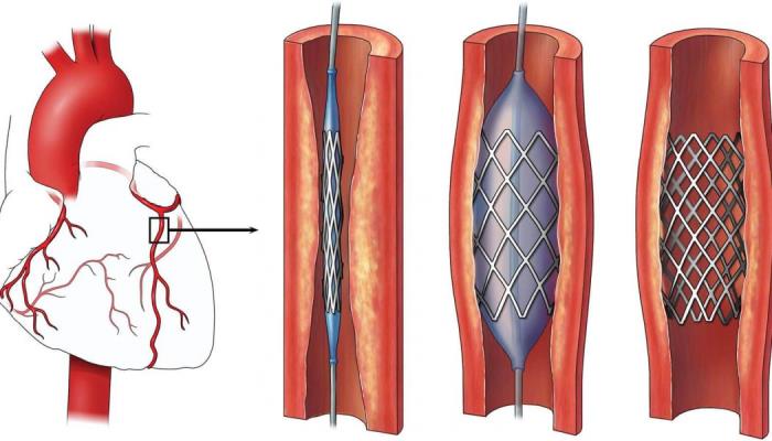 Minimally Invasive Approaches: The Future of Angioplasty