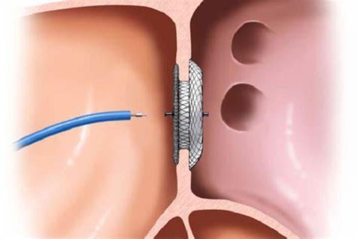 Potential Complications Associated with ASD Closure Devices