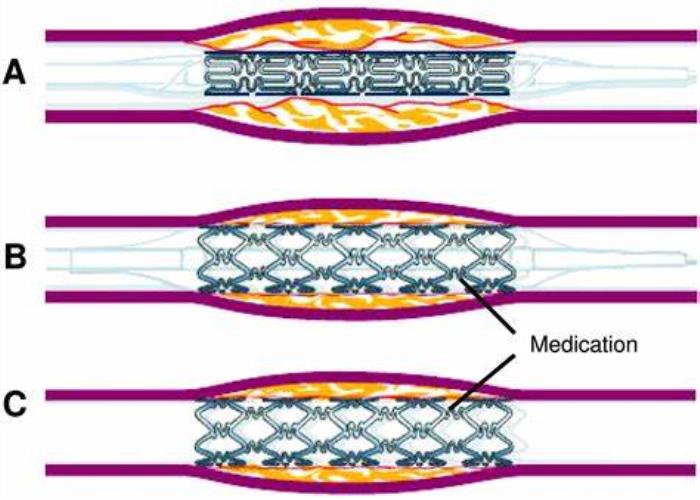 Drug-Eluting Stents