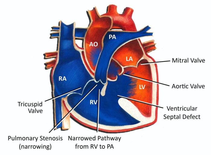 Preventing Infection After Tetralogy of Fallot Surgery