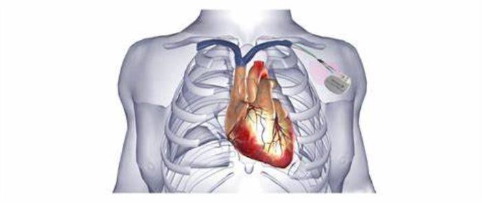 The Role of Pre-Surgery Evaluation in Pacemaker Implantation