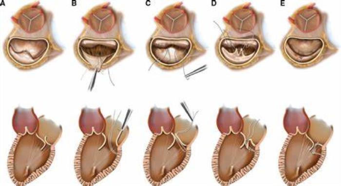 Monitoring Mitral Valve Disease Progression with Regular Echocardiograms