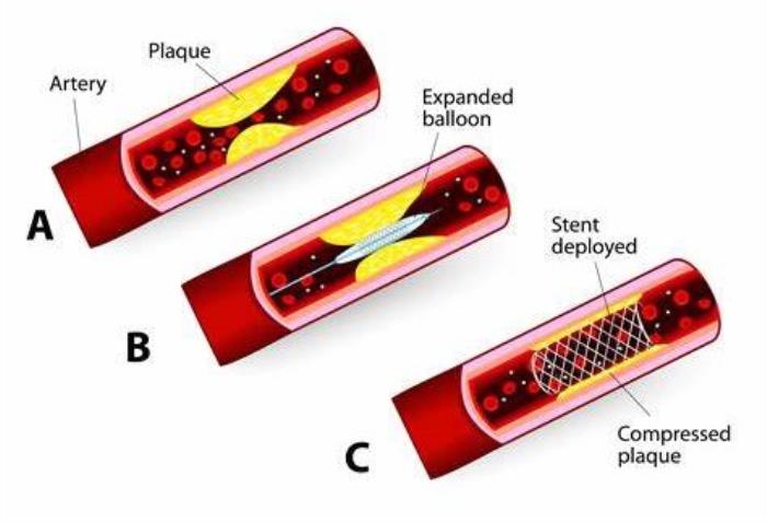 Can 100% Blockage Be Treated with Angioplasty