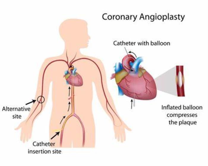 Causes Coronary Artery Blockages Leading to Angioplasty