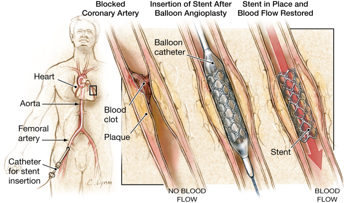 Best Coronary Angioplasty Treatment in India