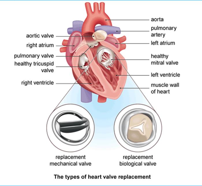 Types of heart valve replacement 