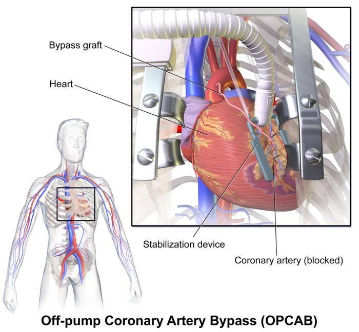 Recent advancements in heart bypass surgery