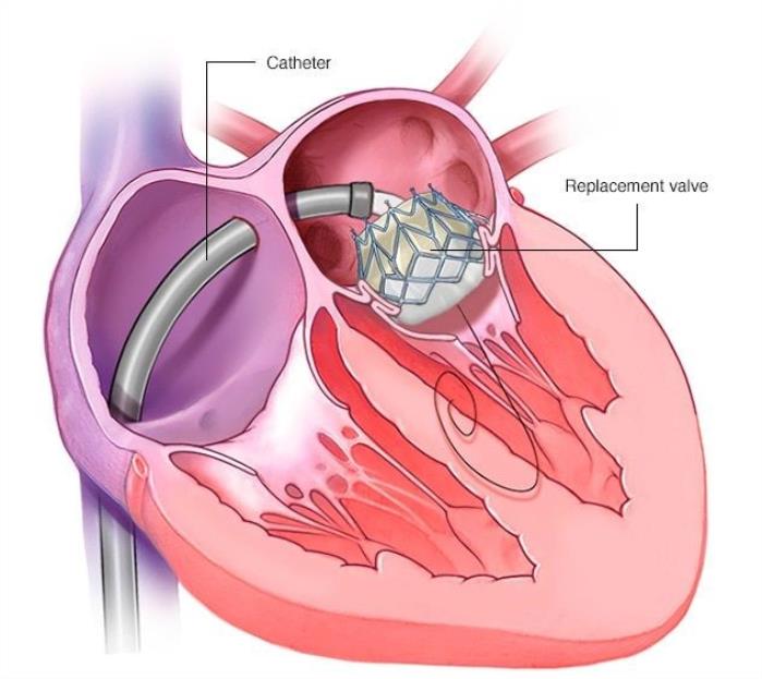 Heart Valve Replacement Surgery recovery time