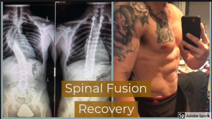 Understanding Spinal Fusion Surgery