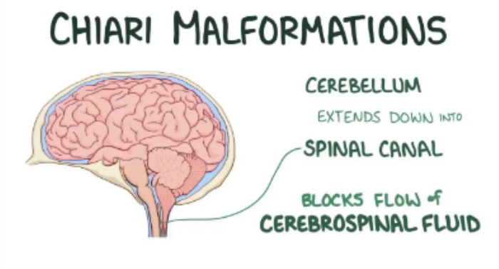 Spinal Fluid Flow Disruptions: A Key Cause of Chiari Malformation